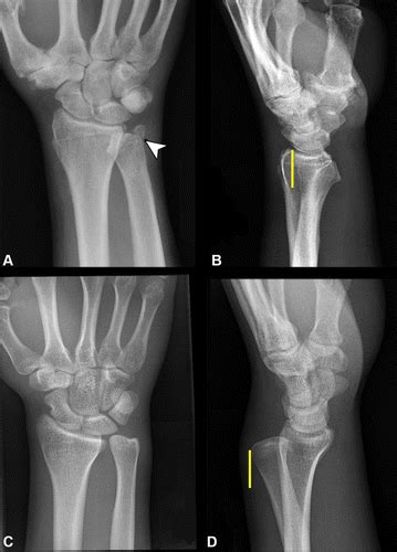 Distal Radioulnar Joint Anatomy