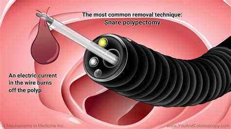 Pin on Colonoscopy positions