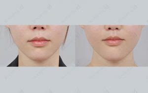 Philtrum reduction that doesn't leave scars 【ID Hospital】