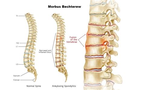 Morbus bechterew behandlung. Morbus Bechterew (Ankylosing Spondylitis – AS ...