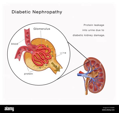 Diabetische Nephropathie. Abbildung einer Niere durch Diabetes mit Protein Leckage beschädigt ...