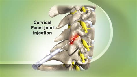 Facet Joint Injection- Indications and Complications | Bone and Spine