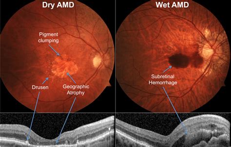 Age-Related Macular Degeneration