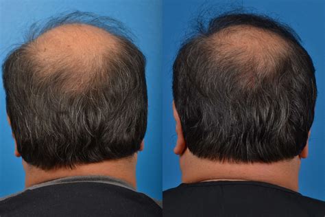 Hair Restoration Photos | Melbourne, FL | Patient 16955