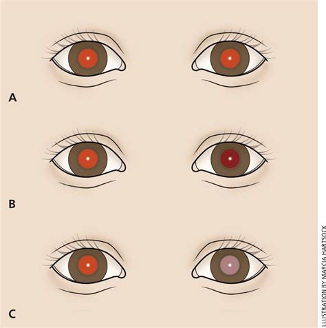 Reflejo rojo. – Neuropediatoolkit