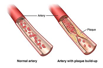 Atherosclerosis | Johns Hopkins Medicine