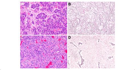 Histologic features of normal adenohypophysis and a pituitary adenoma ...