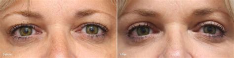 Upper Eyelid Surgery Photos | Princeton, NJ | Patient 8817