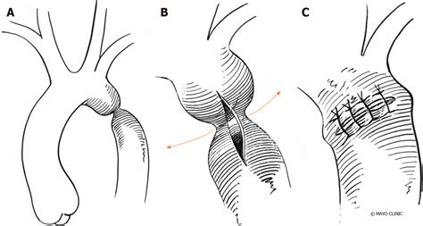 Management of adults with coarctation of aorta