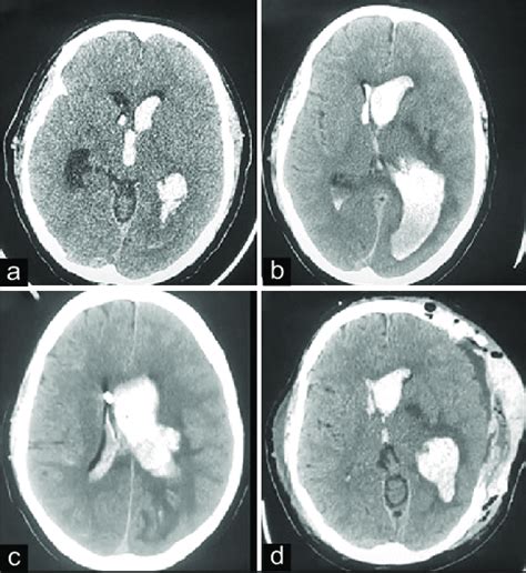 (a) NCCT head showing intraventricular hemorrhage, (b) NCCT head... | Download Scientific Diagram