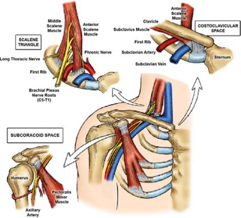 Thoracic Outlet Syndrome - Ryde Natural Health Clinic