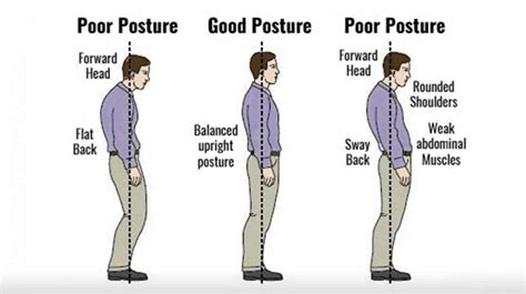 Flat Back Syndrome Causes, Symptoms, Diagnosis and Treatment