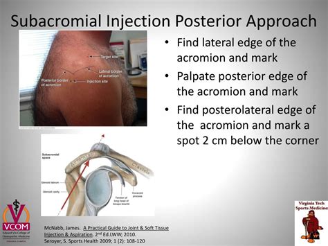 Subacromial Injection