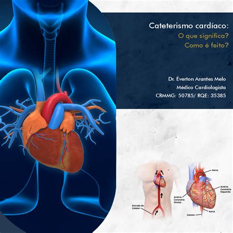 CATETERISMO CARDÍACO: O QUE SIGNIFICA? COMO É FEITO? - PIUMHI HOSPITAL DIA