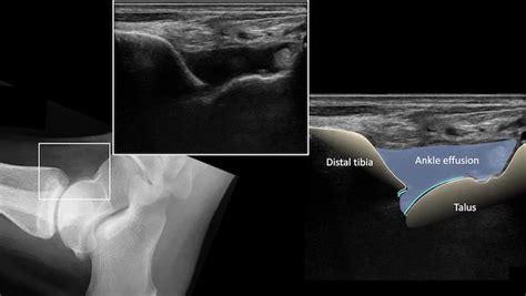 Ultrasound Case 088 • LITFL • POCUS Self-Assessment Quiz