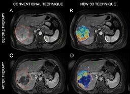 3D MRI Scans May Offer Better Way to Predict Survival After Targeted ...