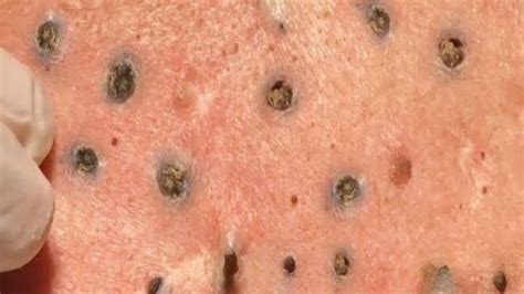 HUGE BLACKHEADS SUCCESSFULLY REMOVED SUFFER FOR HOW MANY YEARS - YouTube