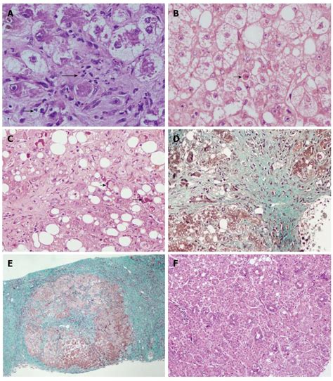 Pathology of alcoholic liver disease, can it be differentiated from ...