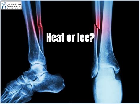 Is Heat Good for a Broken Bone?