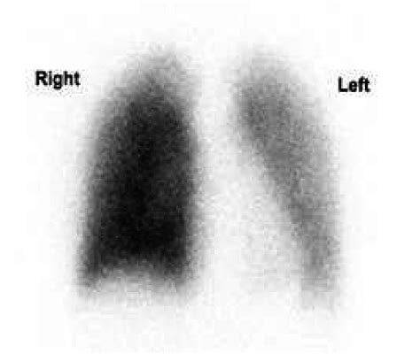 Quantitative lung perfusion scan of a patient with moderately severe... | Download Scientific ...