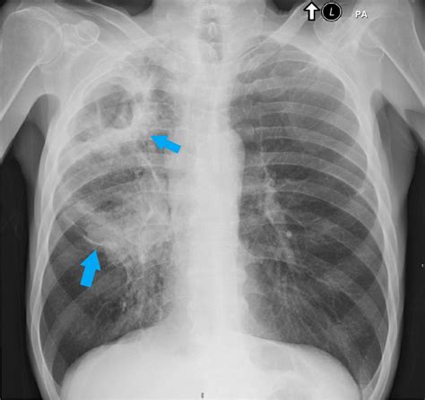 Chest radiograph showing large cavitary lesion in the right upper lung... | Download Scientific ...