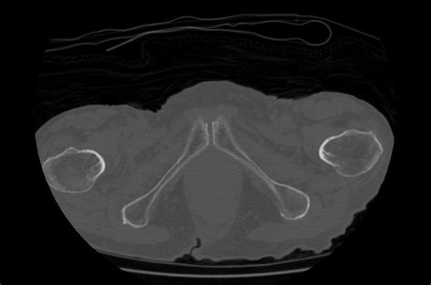 Occult fracture - wikidoc