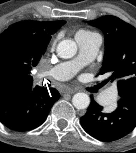 Comprehensive Imaging Review of the Superior Vena Cava | RadioGraphics