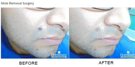 Mole Removal Surgery Service, Laser Treatment, Rs 1000/mole Dermawave ...