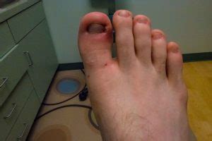 Ingrown Toenail Treatment in Northwest Indiana - Friendly Foot Care