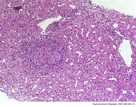 Portal Hypertension Histology