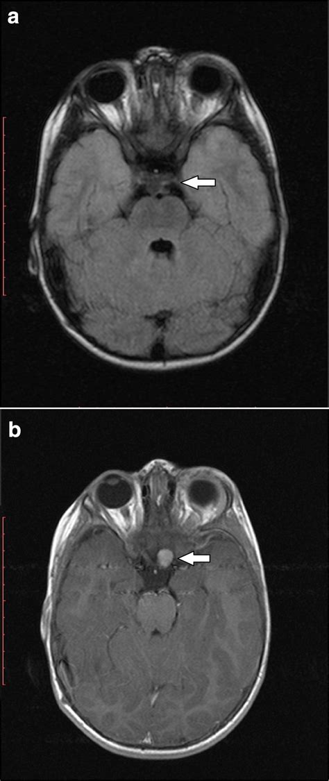 New appearance of an OPG in the left prechiasmatic optic nerve of ...