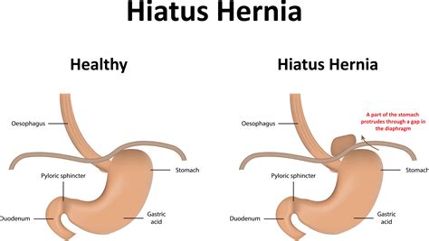 What Size Hiatal Hernia Needs Surgery