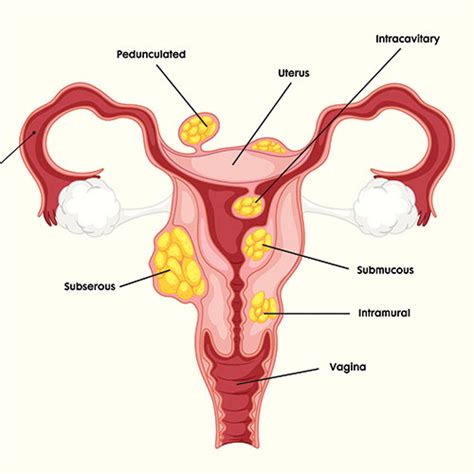 Different types of fibroids | GAURI - Urogynecology Clinic