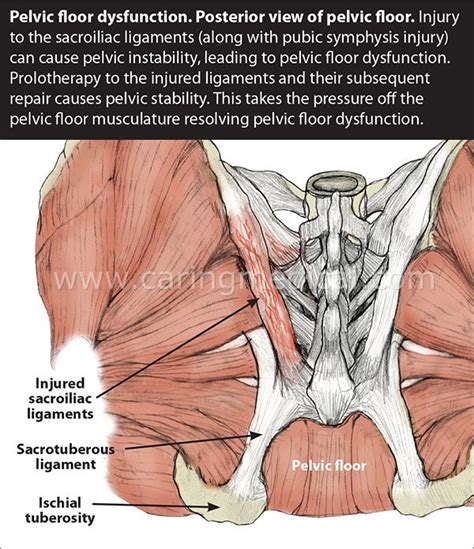 Pelvic Floor Dysfunction Confusing Diagnosis Can Lead To Pelvic Floor Therapy Exercises | Pelvic ...