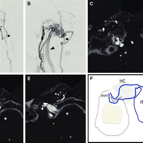 (A) Selective ascending pharyngeal artery angiography before... | Download Scientific Diagram