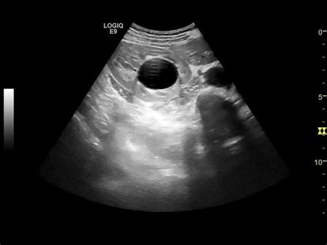 Renal Sinus Ultrasound