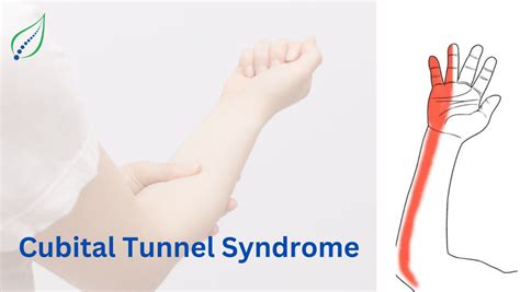 Cubital Tunnel Syndrome: Symptoms, Causes & Treatments | Best Back Pain ...