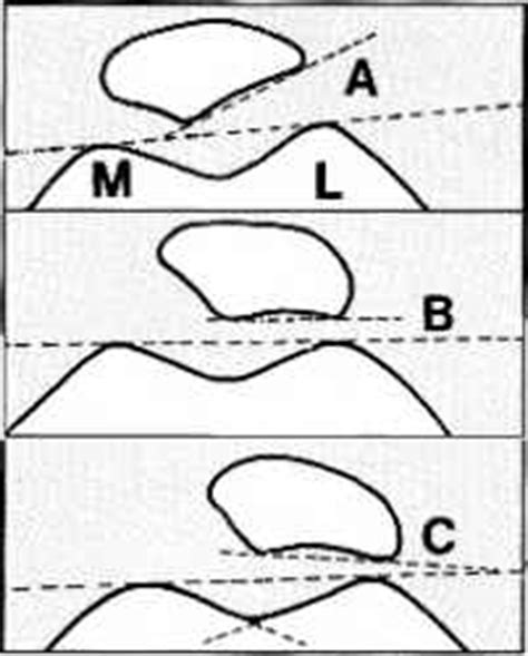 Patella Skyline View - Rheumatoid Arthritis - Arthritis Research