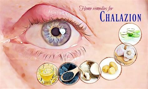 38 Natural Home Remedies For Chalazion Cysts On The Eyelid