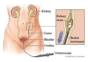 Laser Lithotripsy