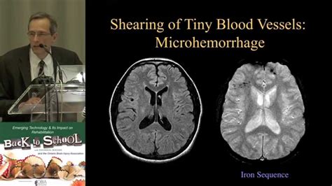 MRI of Truamatic Brain Injury by Dr. David J Mikulis - YouTube