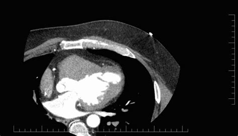 Basic Processing in Cardiac MRI: Tips and Tricks - BiomedJ