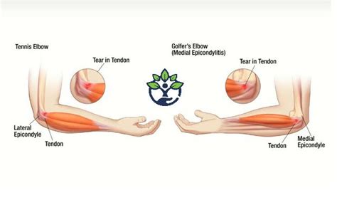 Tennis & Golfer's Elbow Prevention | Golfers elbow, Tennis elbow ...