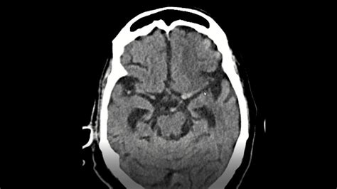 Dense MCA sign on plain CT scan of brain - YouTube