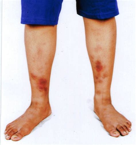 Erythema Nodosum-Red nodules-Patches-Pain on shins