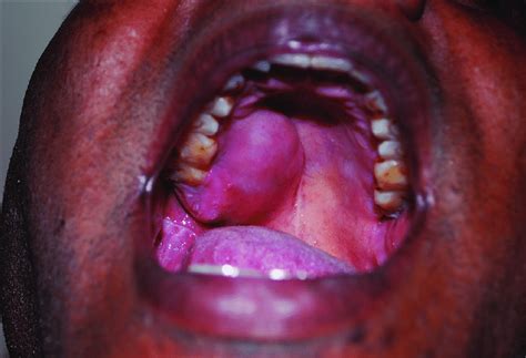 Intra-oral picture showing swelling in the right posterior aspect of... | Download High-Quality ...