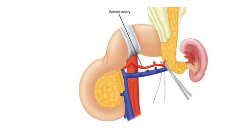 Distal Pancreatectomy – South Florida Sugical Oncology