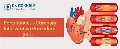 Percutaneous Coronary Intervention Procedure | Dr Gokhale