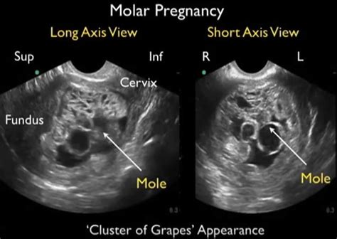 Molar Pregnancy, Hydatidiform Mole - Causes, Symptoms, Treatment