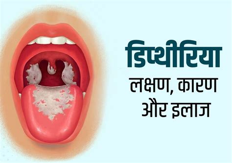 Diphtheria: बहुत ही घातक बीमारी है डिप्थीरिया, जानिए लक्षण, कारण और इलाज